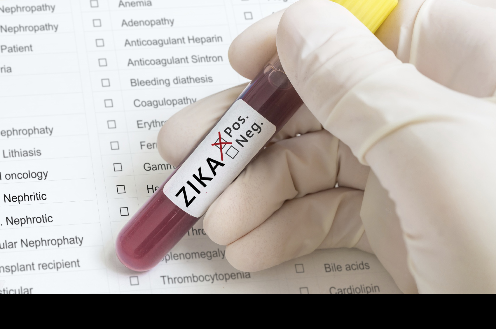 El Servicio de Salud Pública confirmoó los dos primeros casos de niños nacidos con microcefalia asociada al zika durante su gestación