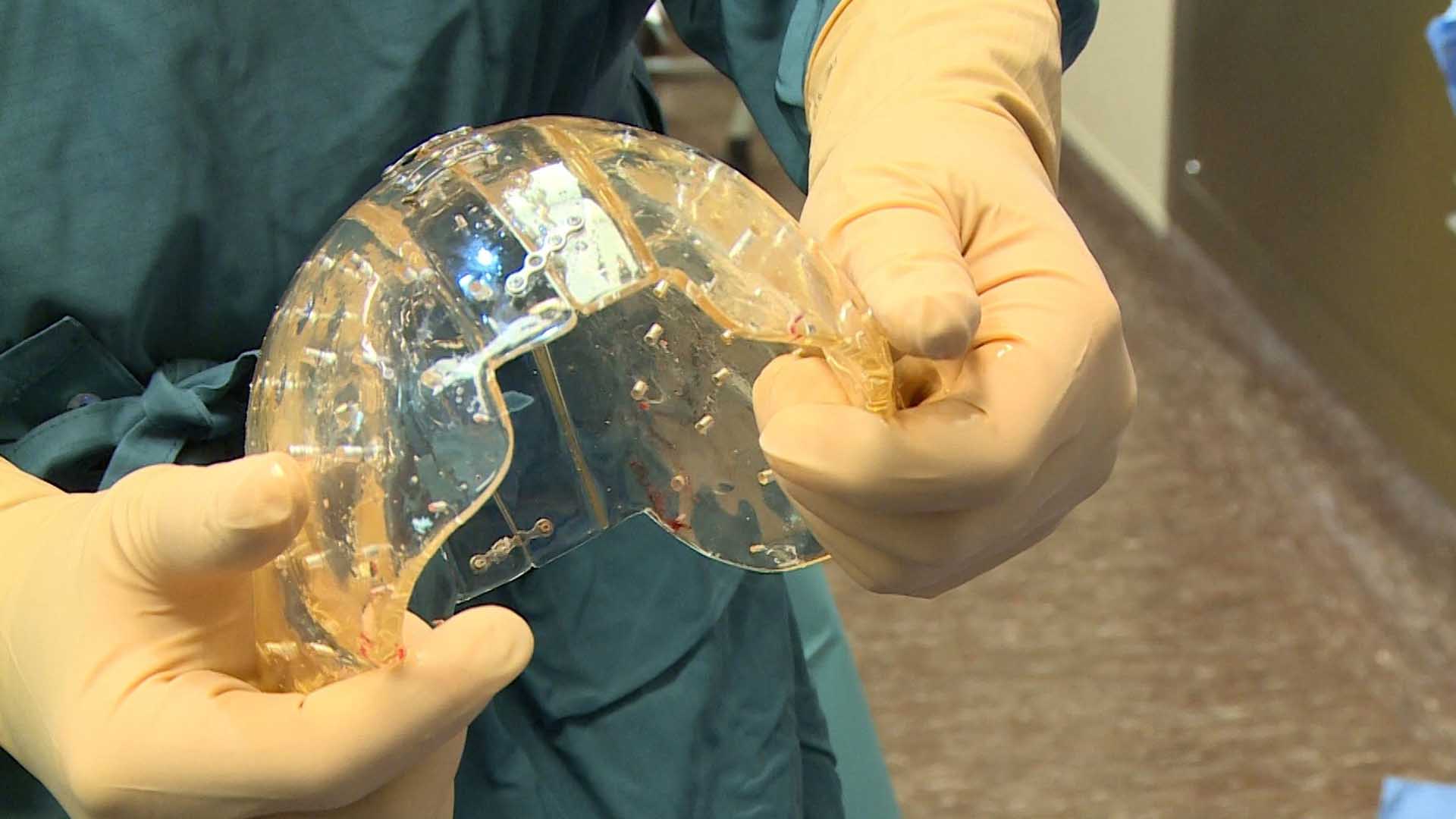 En el Hospital Universitario de Ultrecht fue realizada la operación, hasta ahora los implantes eran tan solo temporales o parciales