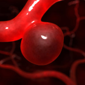 Así luce una zona débil en la pared de un vaso sanguíneo 