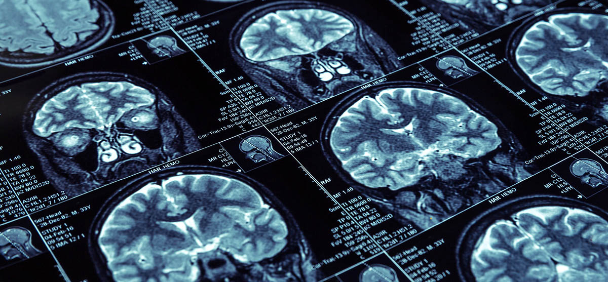 Las pruebas realizadas en laboratorio permiten detectar la conectividad cerebral antes de que se presenten los síntomas