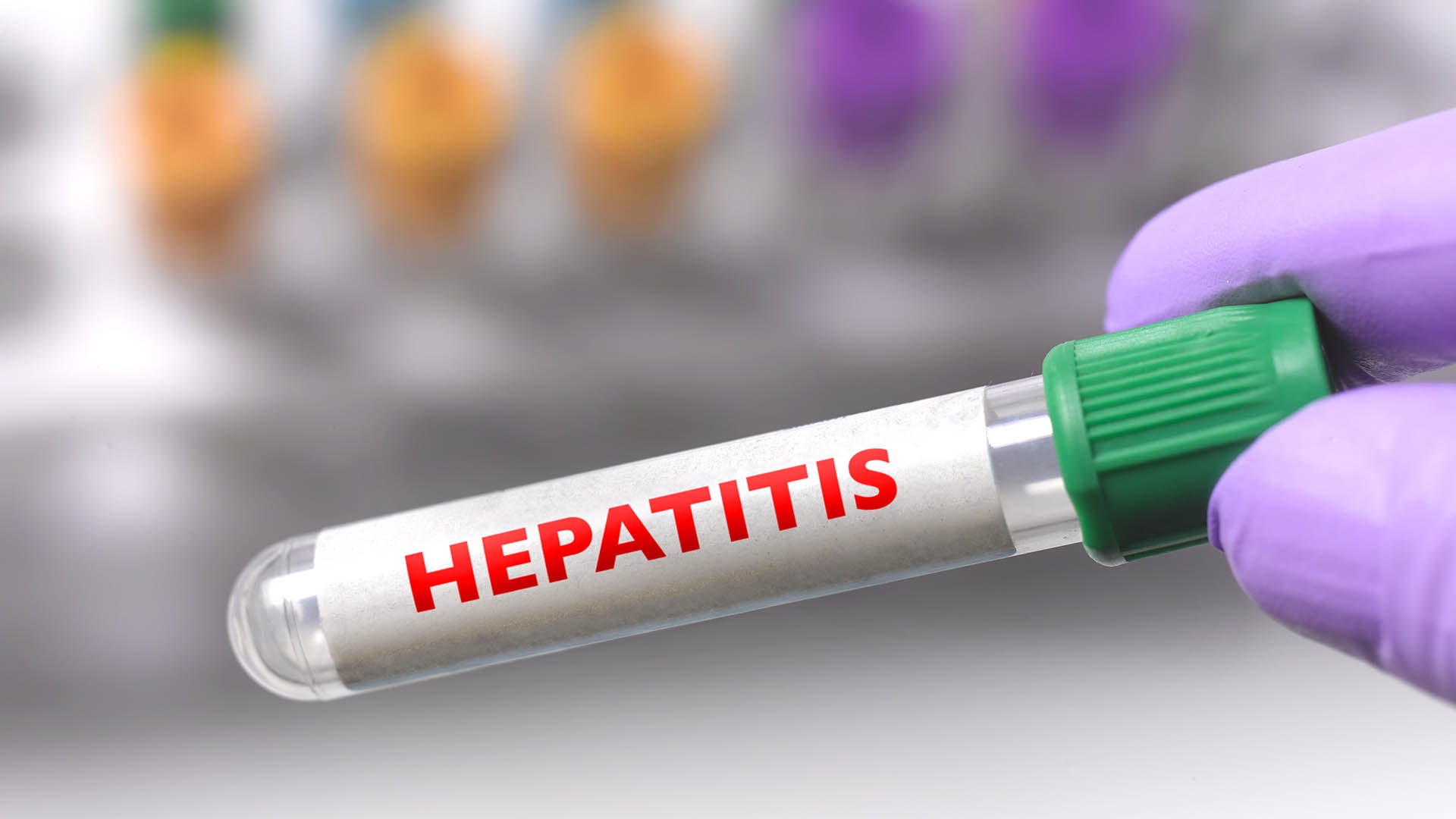 hepatitis aguda 